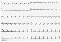 Abbildung 3: Brugada-Syndrom
