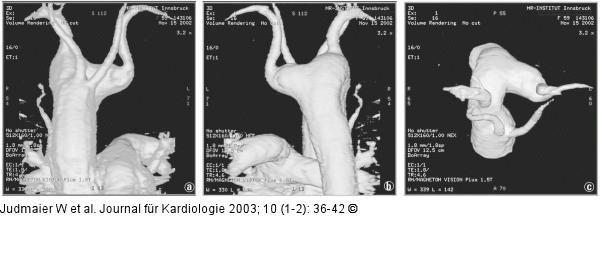 Magnetresonanzangiographie, Arteria subclavia