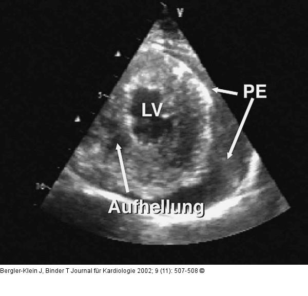Metastasiertes Melanom - Kardiale Manifestation