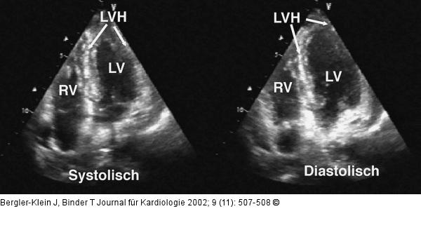 Metastasiertes Melanom - Kardiale Manifestation