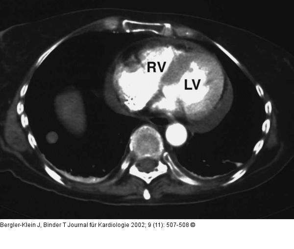 Metastasiertes Melanom - Kardiale Manifestation