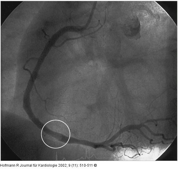 Mobiler Thrombus in der RCA bei NSTEMI