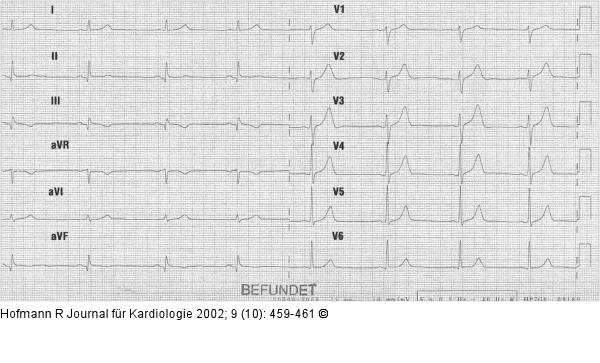 ST-Hebung nach Thalliumszintigraphie