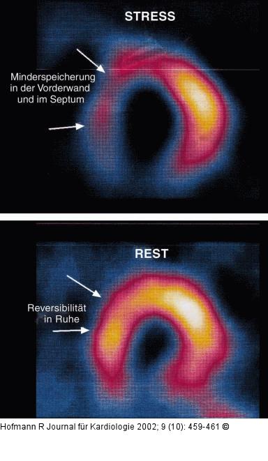 ST-Hebung nach Thalliumszintigraphie