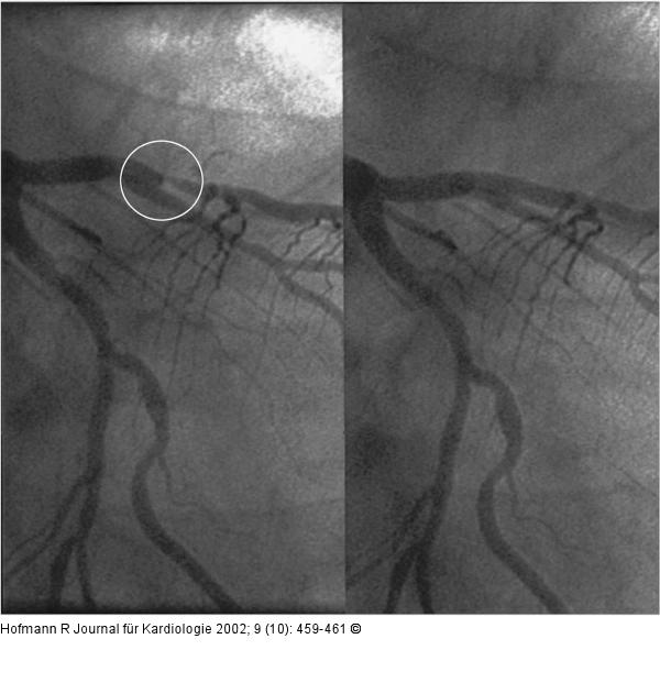 ST-Hebung nach Thalliumszintigraphie