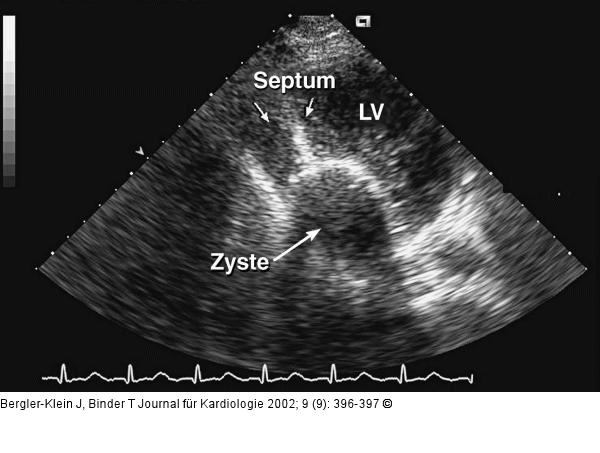 Intramyokardiale Echinokokkus-Zyste