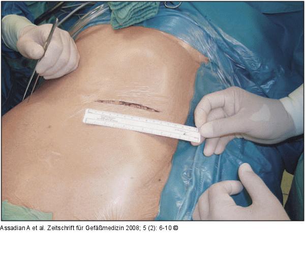 Retroperitonealer Zugang