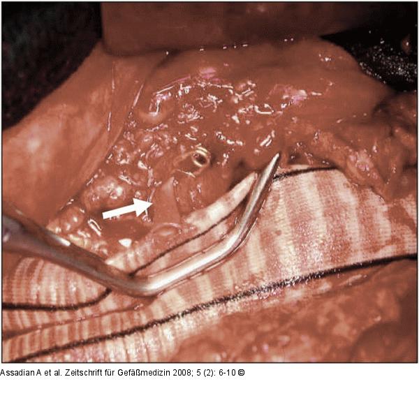 Bifurkationsprothese 