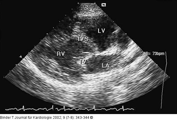 Kongenital korrigierte Transposition der großen Gefäße (ccTGA)