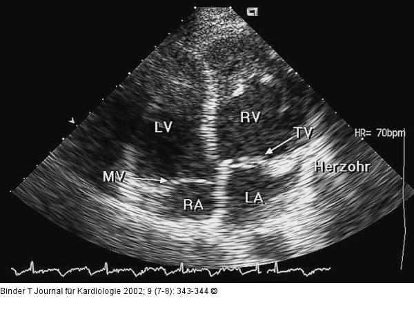 Kongenital korrigierte Transposition der großen Gefäße (ccTGA)