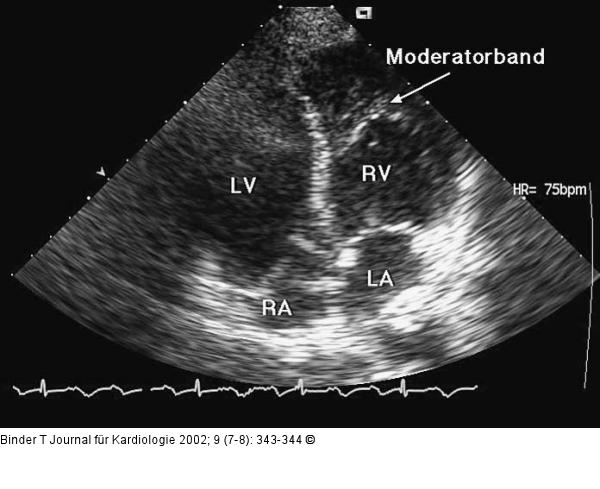 Kongenital korrigierte Transposition der großen Gefäße (ccTGA)