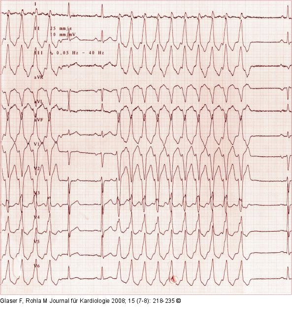 Ausflusstrakt-Tachykardie