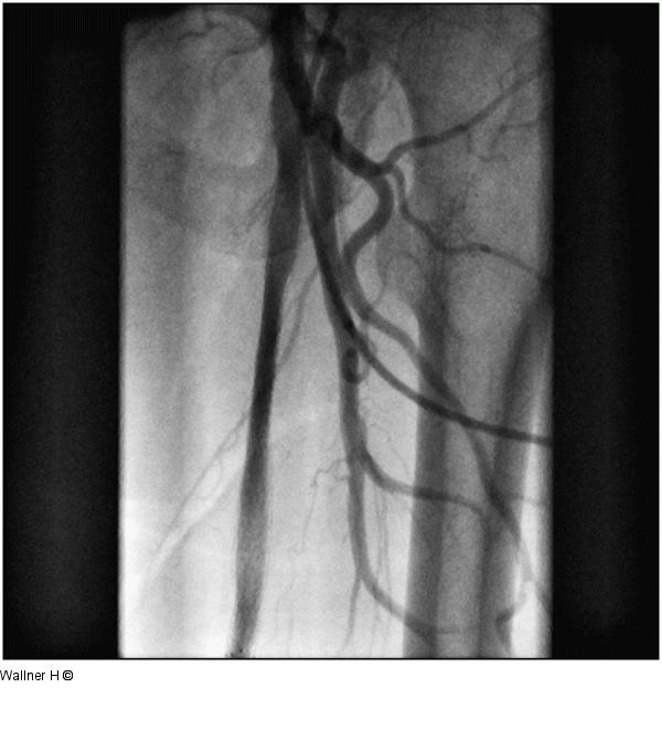 Perkutane transpopliteale retrograde Rekanalisation