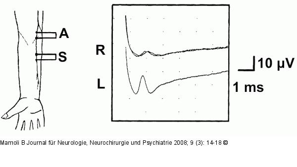 N. atebrachii medialis