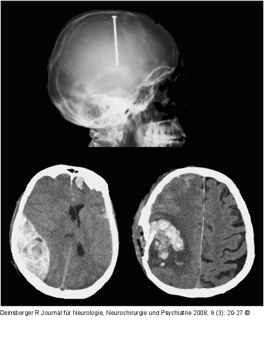 Nagelschussverletzung