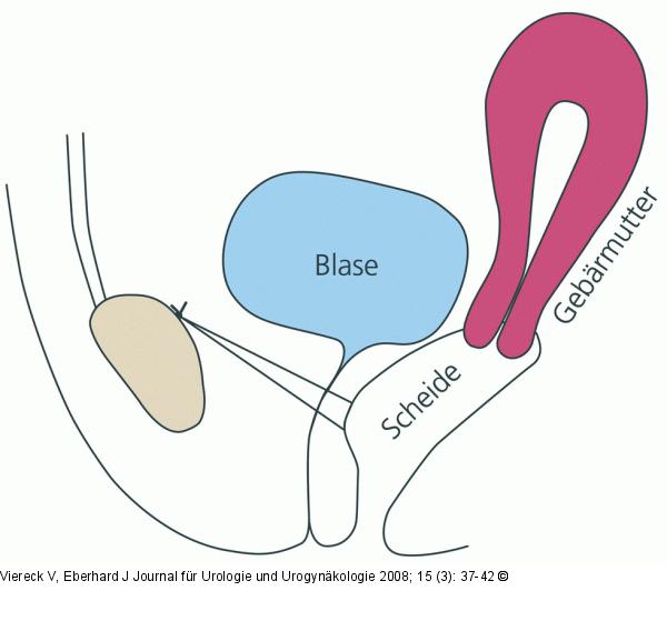 Kolposuspensions-Operation