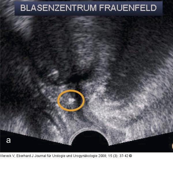 Introitussonographie