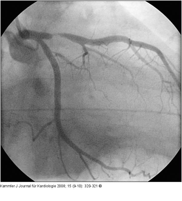 Transmurale Ischämie - Erstickungs-T-Wellen