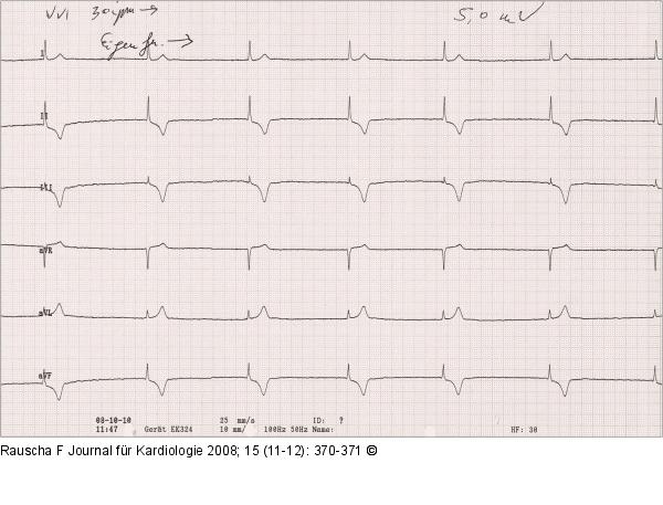 EKG