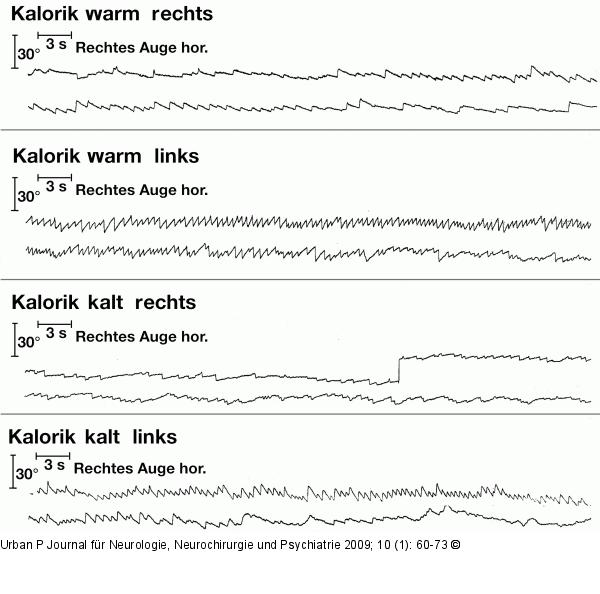 Elektronystagmogramm