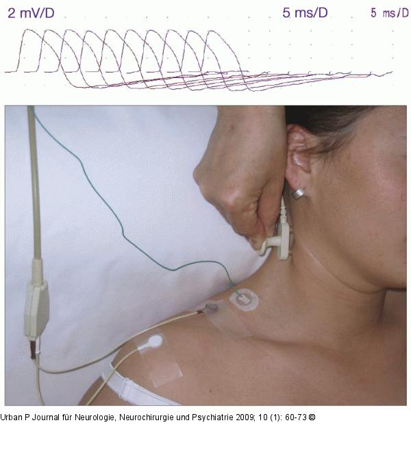 Repetitive Stimulation