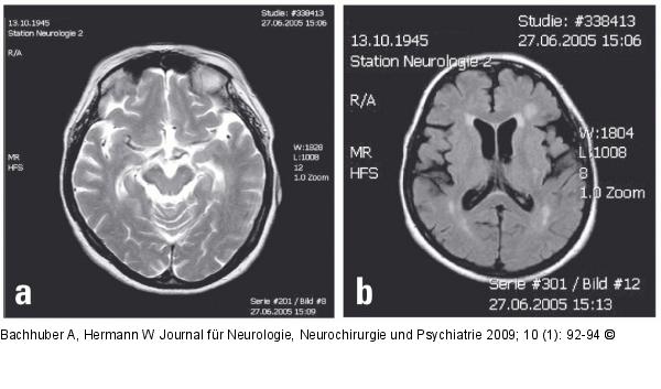 Steele-Richardson-Olszewski-Syndrom
