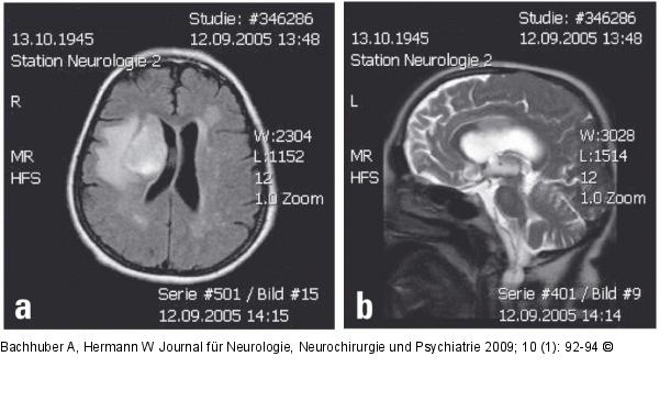 Steele-Richardson-Olszewski-Syndrom