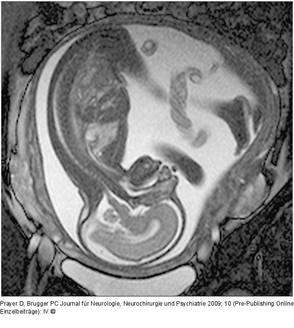 Fetus - Sagittale Schichtführung