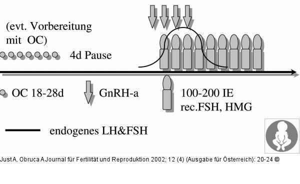 Ovarielle Stimulation - ultrakurzes Stimulationsprotokoll