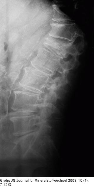 Osteoporotische Wirbelkörperfraktur