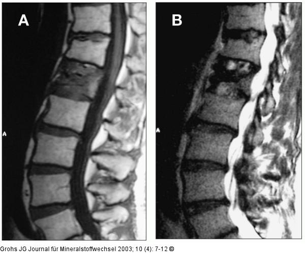 Fraktur - hypointens - hyperintens