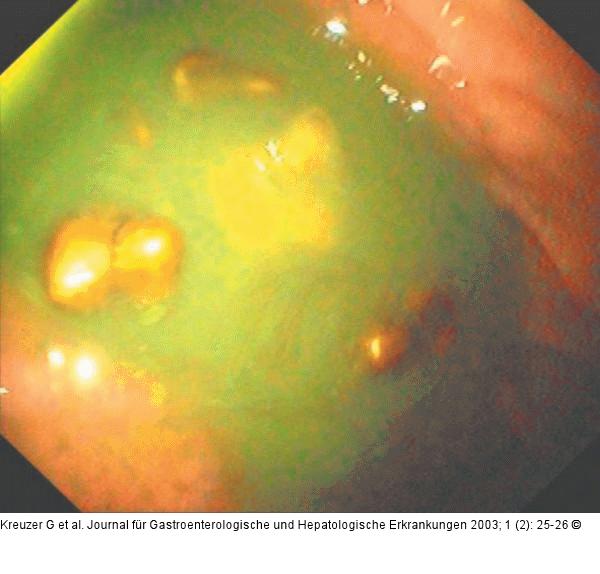 Corpus ventriculi - Gastroskopie