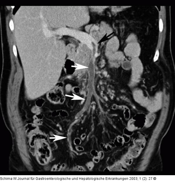 Mesenterialvenenthrombose