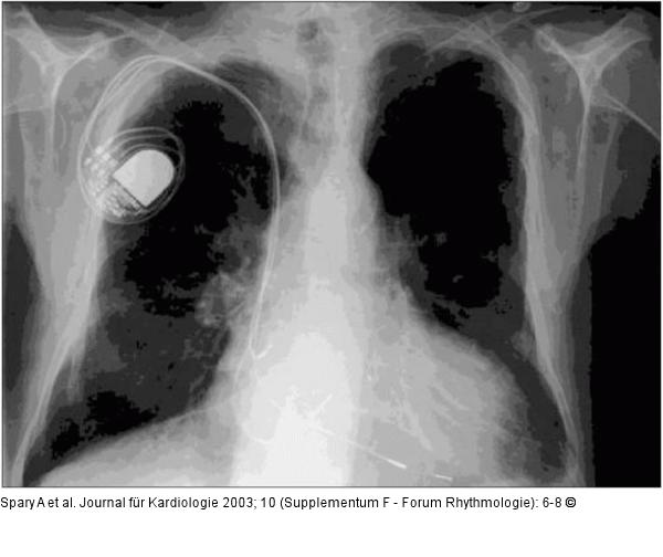 Biventrikulärer Herzschrittmacher