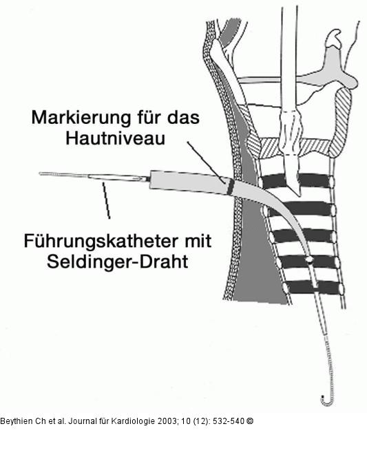 Perkutane Dilatationstracheotomie