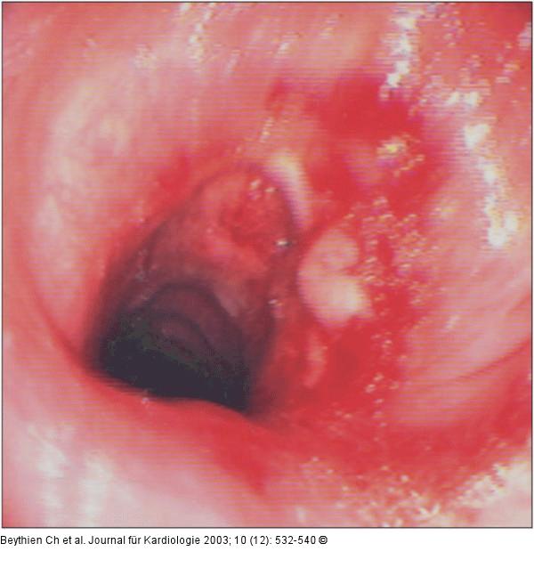 Trachea - Stenose - Lasertherapie