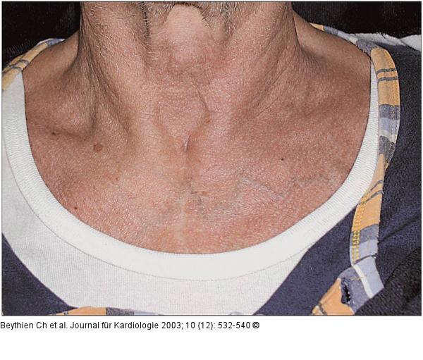 Perkutane Dilatationstracheotomie