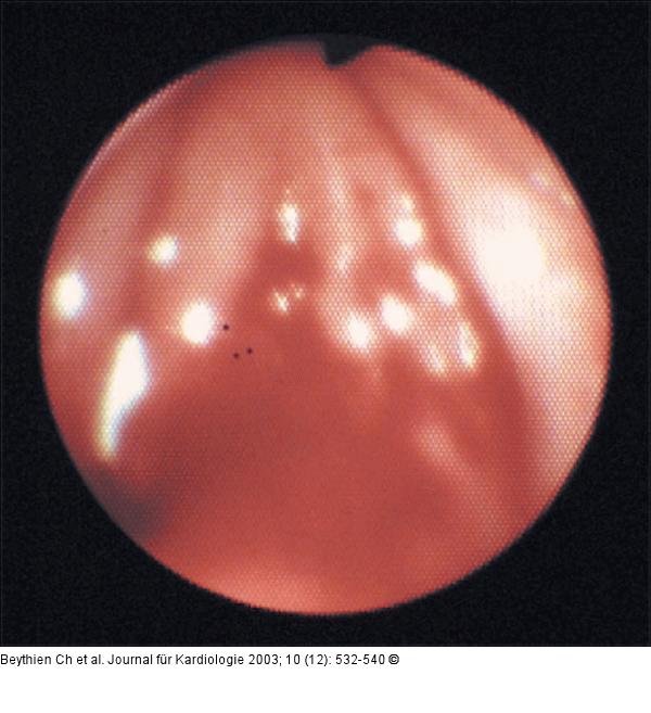 Stimmbänder - Schleimhautläsion
