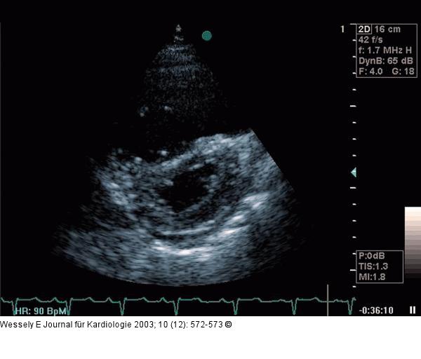 Pulmonale Hypertonie