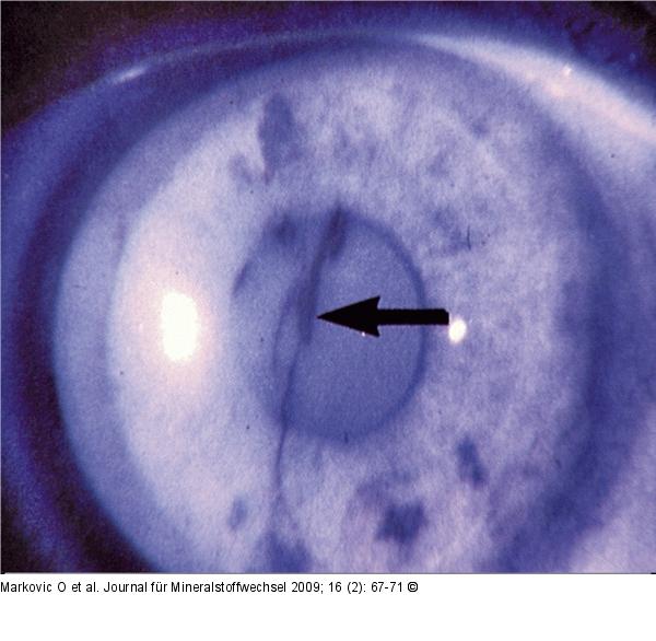 Tränenfilmaufrisszeit