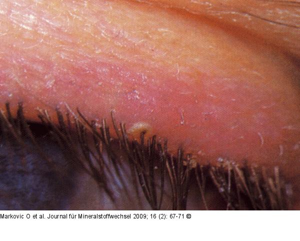 Blepharitis