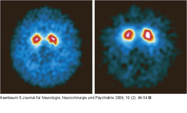 Dopamin-Transporter