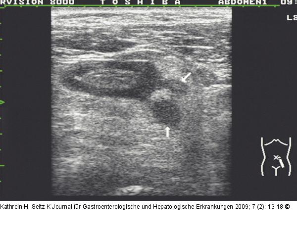 Divertikulitis - Peridivertikulitis