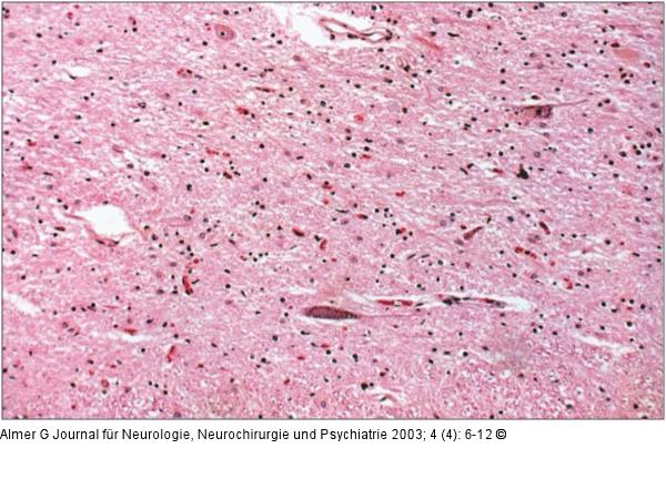 ALS - Neuropathologie