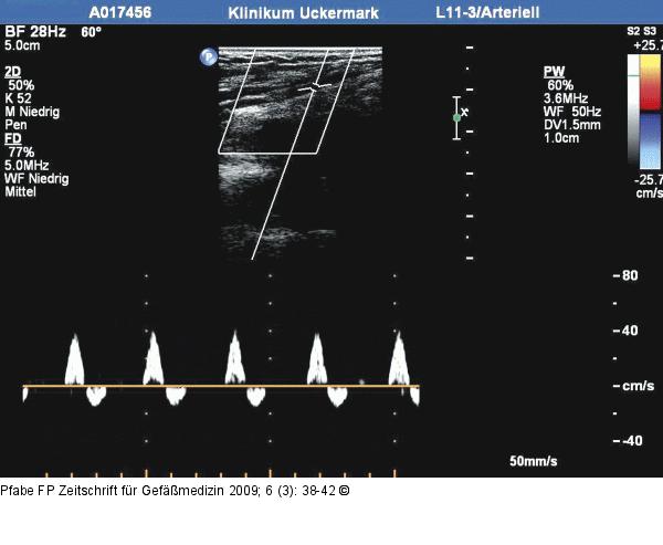 Arteria tibialis posterior