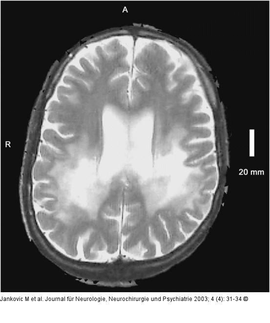 Adrenomyeloneuropathie