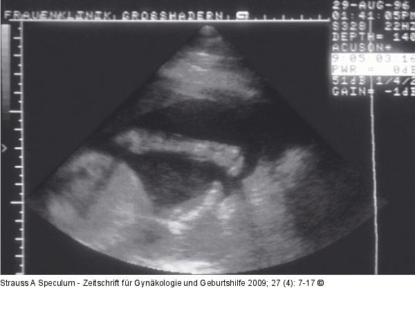 Fetus - Extremitätendefekt