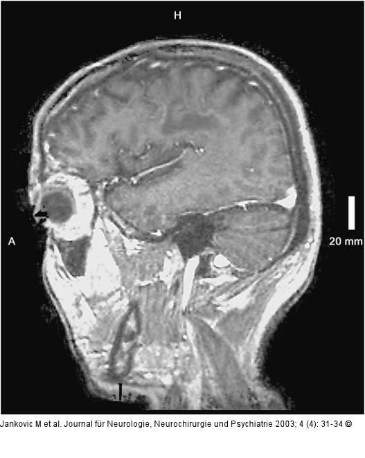 Adrenomyeloneuropathie