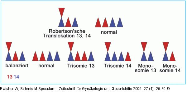 Robertson'sche Translokation