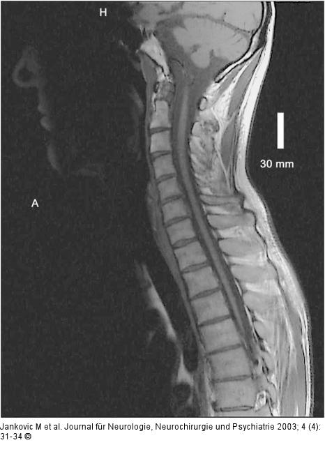 Adrenomyeloneuropathie